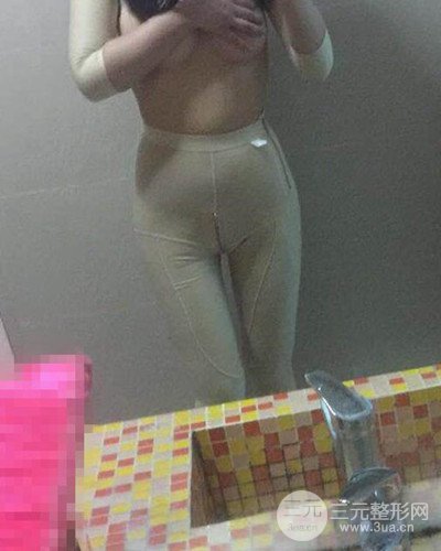 廣州韓妃大腿吸脂案例，恢復(fù)過(guò)程前后對(duì)比圖片分享~