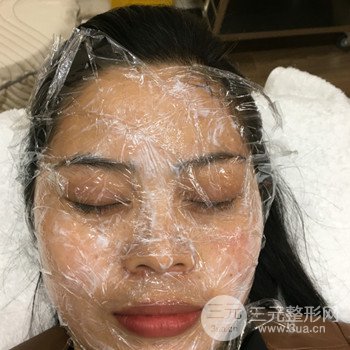 廣州激光祛雀斑果不反彈、恢復(fù)過程圖片分享