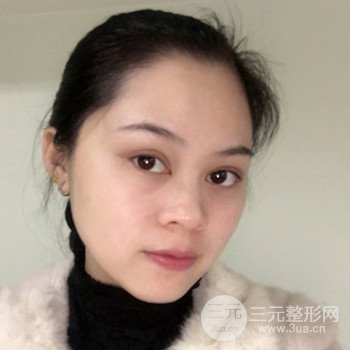 廣州激光祛雀斑果不反彈、恢復(fù)過程圖片分享