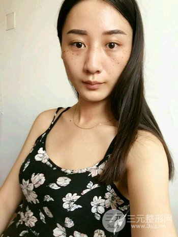 朱彤玥激光祛斑案例、兩個(gè)月果對(duì)比超明X