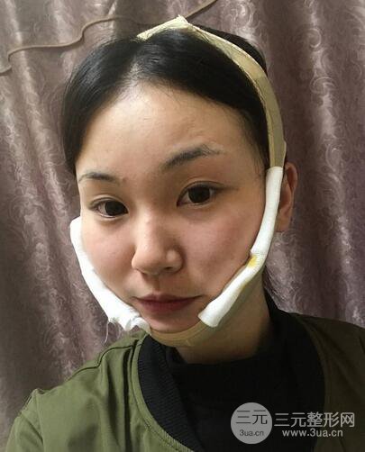下頜角磨骨整形全過(guò)程分享，附上術(shù)后恢復(fù)照片~