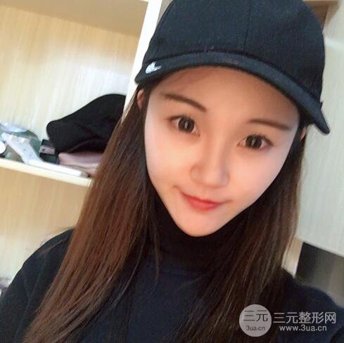 下頜角磨骨整形全過(guò)程分享，附上術(shù)后恢復(fù)照片~