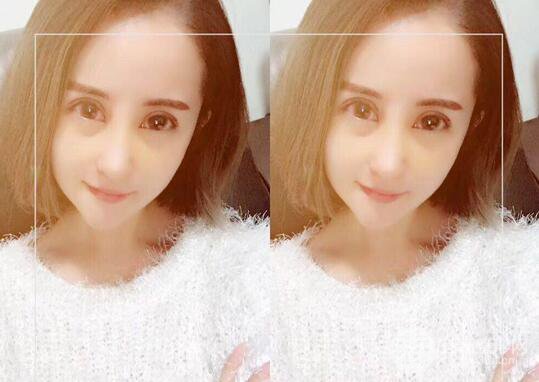 硅膠隆鼻術(shù)前術(shù)后對(duì)比照片分享，走上顏值頂峰