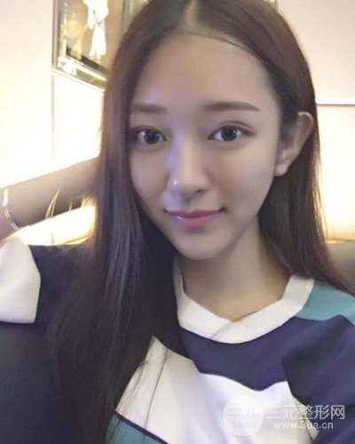 深圳蒳美邇黃海彬雙眼皮案例恢復(fù)過程對比圖分享~