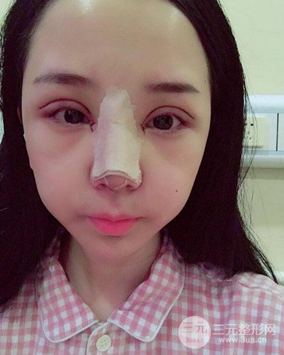 深圳蒳美邇朱燦醫(yī)生眼隆鼻整形案例分享，附上前后對比照~