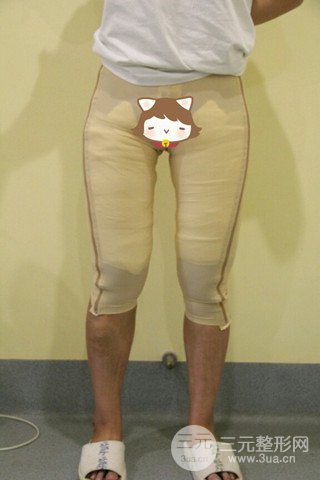 大腿抽脂果好到不行、瘦十厘米不是問題