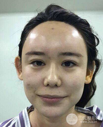 全臉自體脂肪填充，填充不飽滿還可以瘦臉_真人案例