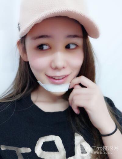 全臉自體脂肪填充，填充不飽滿還可以瘦臉_真人案例