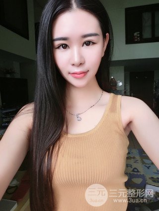 深圳全切雙眼皮修復(fù)成功案例恢復(fù)過程分享