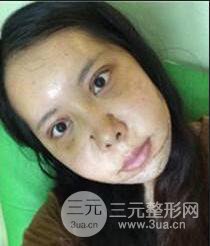 顴骨磨骨改臉型過程和恢復(fù)步驟照片（圖）