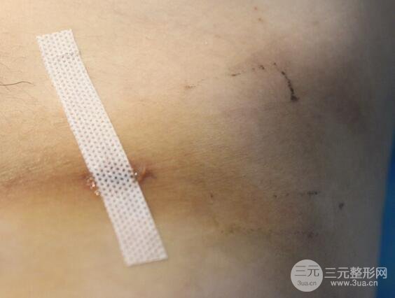 九院曹衛(wèi)剛自體脂肪面部填充案例