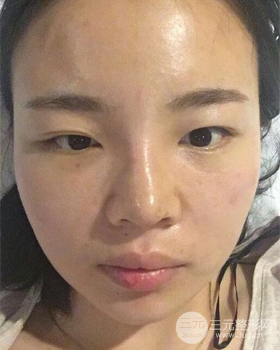 蘇州美萊尹飛隆鼻整形案例，前后恢復(fù)圖分享~