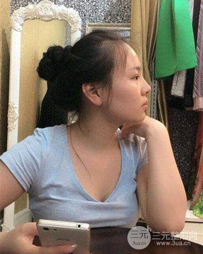 蘇州美萊尹飛隆鼻整形案例，前后恢復(fù)圖分享~