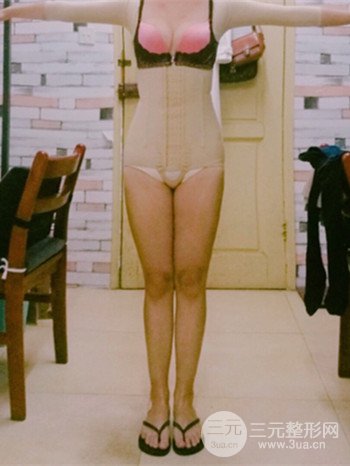 濟南腰腹吸脂案例三個月前后變化圖片分享