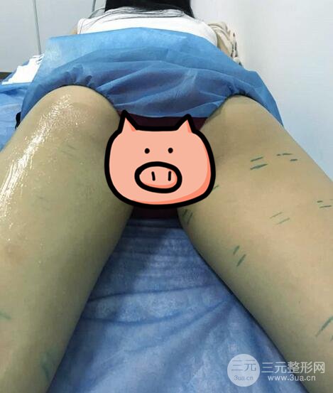 曹衛(wèi)剛大腿吸脂案例恢復(fù)圖片記錄分享