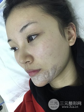 濟南硅膠假體墊下巴真人案例、下巴改變整個臉型