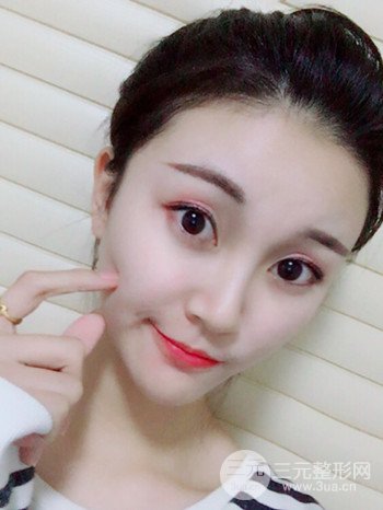 濟南硅膠假體墊下巴真人案例、下巴改變整個臉型