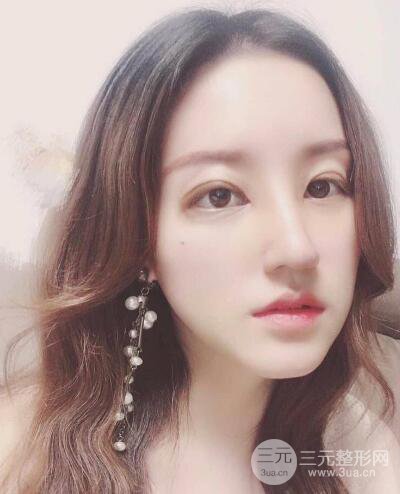 顧陸健做鼻子隆鼻案例術后恢復果分享