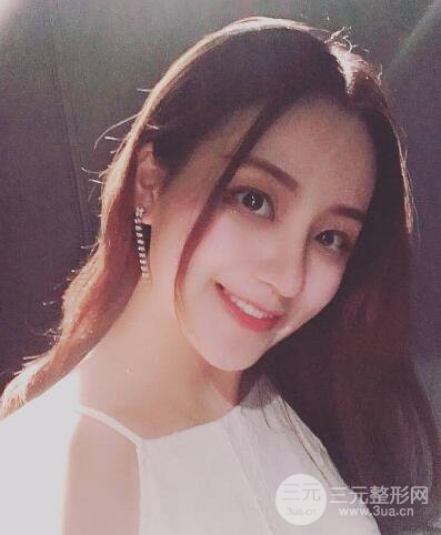 顧陸健做鼻子隆鼻案例術后恢復果分享