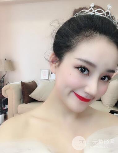 顧陸健做鼻子隆鼻案例術后恢復果分享