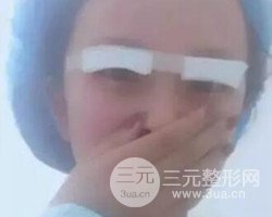南京鼓樓譚謙醫(yī)生切開雙眼皮案例，恢復(fù)圖分享~