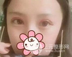 南京鼓樓譚謙醫(yī)生切開雙眼皮案例，恢復(fù)圖分享~