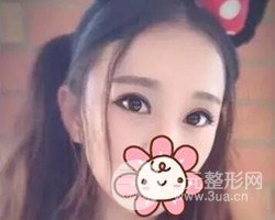 南京鼓樓譚謙醫(yī)生切開雙眼皮案例，恢復(fù)圖分享~