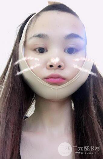 磨骨瘦臉（下頜角切除）恢復(fù)過(guò)程及前后對(duì)比照片