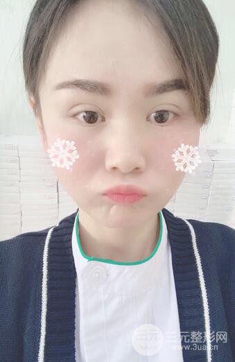 磨骨瘦臉（下頜角切除）恢復(fù)過(guò)程及前后對(duì)比照片