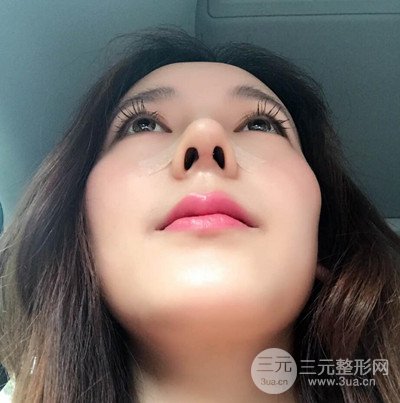 成都華顏黃富偉自體軟骨隆鼻案例前后對比圖分享