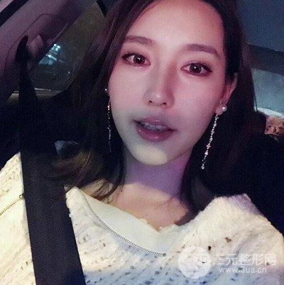 成都華顏黃富偉自體軟骨隆鼻案例前后對比圖分享