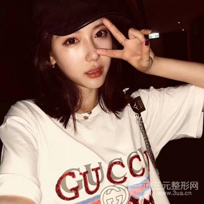 成都華顏黃富偉自體軟骨隆鼻案例前后對比圖分享