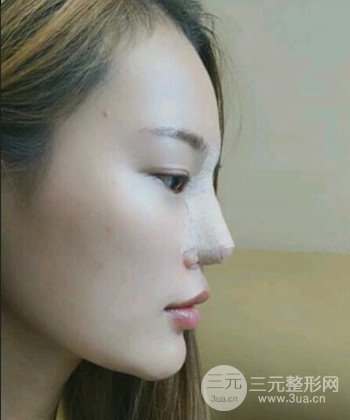 模特做隆鼻整形真實日記分享，附上恢復過程圖