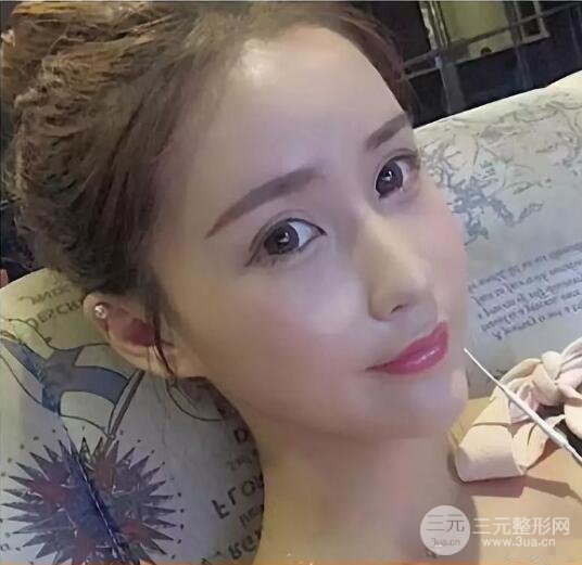 王明利自體脂肪填充案例恢復(fù)過(guò)程分享