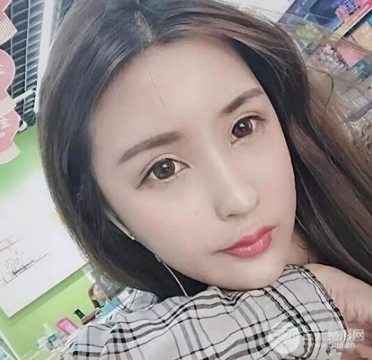 王明利自體脂肪填充案例恢復(fù)過(guò)程分享