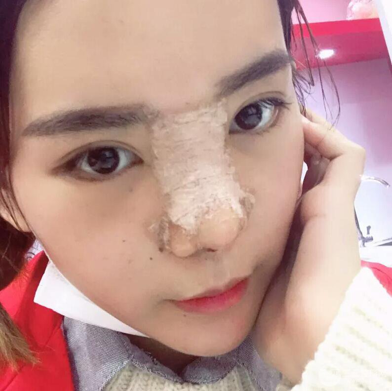 硅膠隆鼻+自體耳軟骨墊鼻尖案例前后對(duì)比照片分享