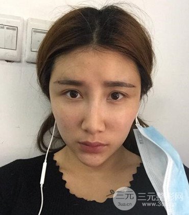 網(wǎng)絡(luò)主播做自體脂肪豐太陽穴真實(shí)案例分享，果杠杠的