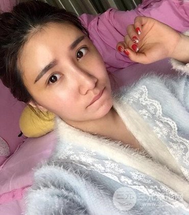 網(wǎng)絡(luò)主播做自體脂肪豐太陽穴真實(shí)案例分享，果杠杠的