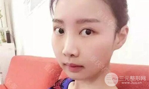 重慶華美潘寶華磨骨怎么樣?整形案例恢復(fù)圖片分享