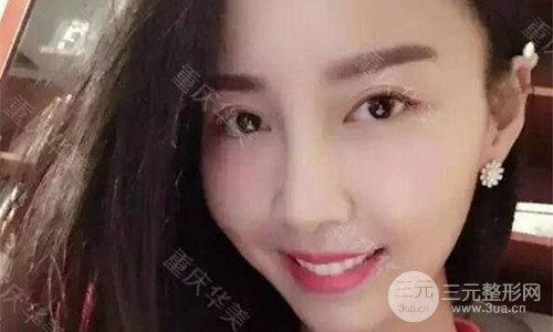 重慶華美潘寶華磨骨怎么樣?整形案例恢復(fù)圖片分享