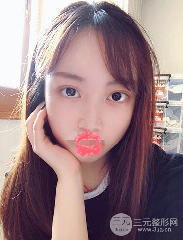 華美許再榮雙眼皮案例恢復(fù)果,閉眼微創(chuàng)~