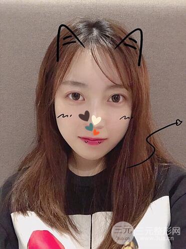 華美許再榮雙眼皮案例恢復(fù)果,閉眼微創(chuàng)~