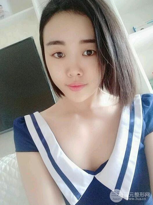 成都軍大鐘正強(qiáng)自體脂肪填充面部案例恢復(fù)圖，馬上變成“初戀臉”