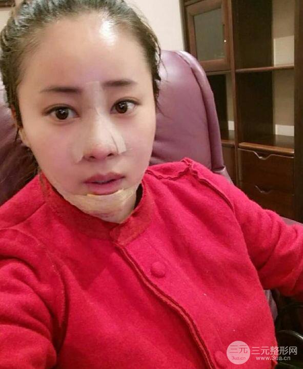 成都華顏賈德淵隆鼻失敗修復(fù)真實(shí)案例分享，并且附上前后對(duì)比照片