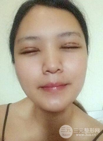 深圳雙眼皮正就內雙小眼睛，真實案例前后對比照片