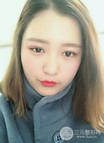 深圳雙眼皮正就內雙小眼睛，真實案例前后對比照片