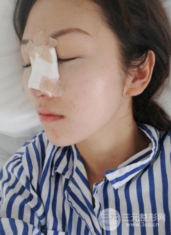廣州隆鼻整形真實恢復(fù)期圖片，擁有精致美鼻不是夢