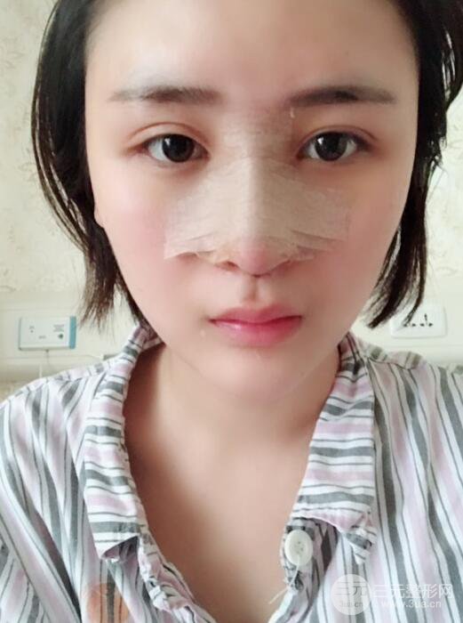 重慶五洲范文亮隆鼻整形案例，前后對比圖分享