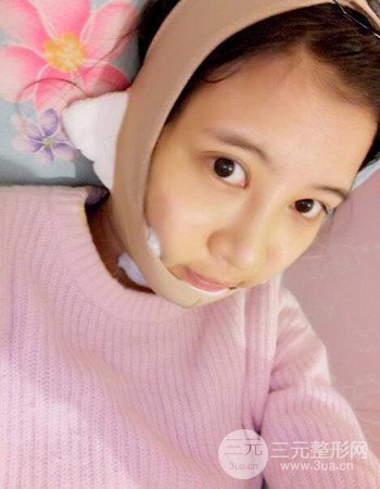 北京吸脂瘦臉真人案例恢復(fù)過程分享，巴掌小臉不是夢(mèng)