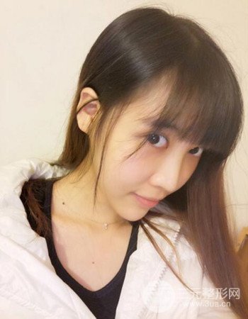 北京吸脂瘦臉真人案例恢復(fù)過程分享，巴掌小臉不是夢(mèng)